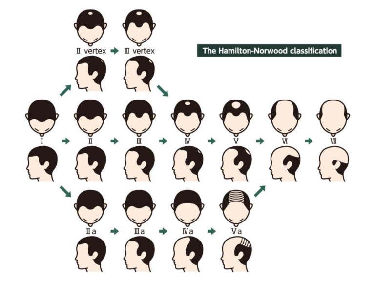 AGAの進行パターン